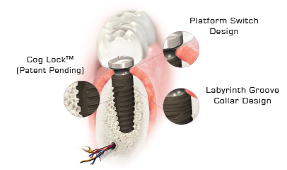StarVent Internal Hex Implant Features